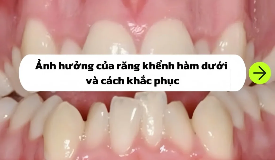 răng khểnh hàm dưới