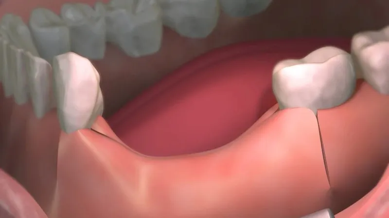 Mất răng lâu năm có trồng được không