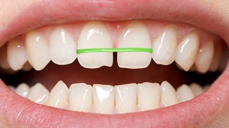 nieng-rang-tai-nha-2