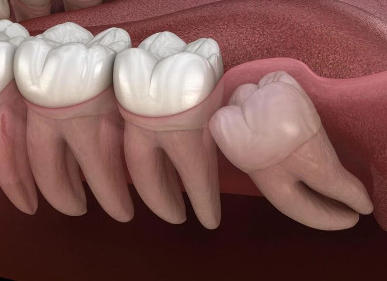 rang-moc-ngam-co-can-nho-khong-1