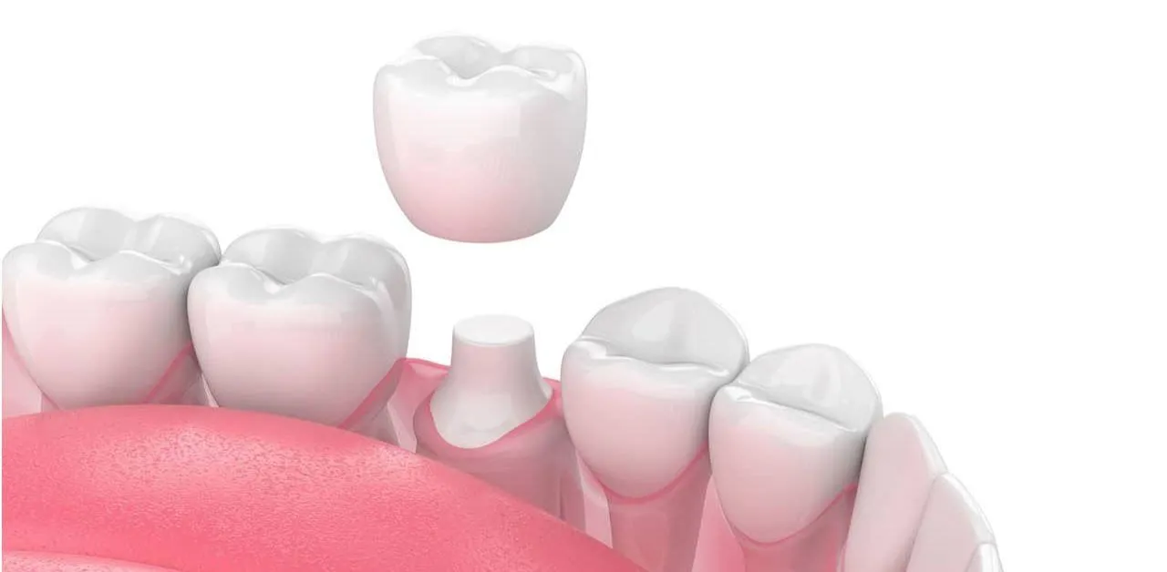 bọc răng sứ có phải mài răng không