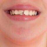 Giải Pháp Khi Bạn Bị Mẻ Răng