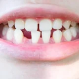 trẻ không có mầm răng