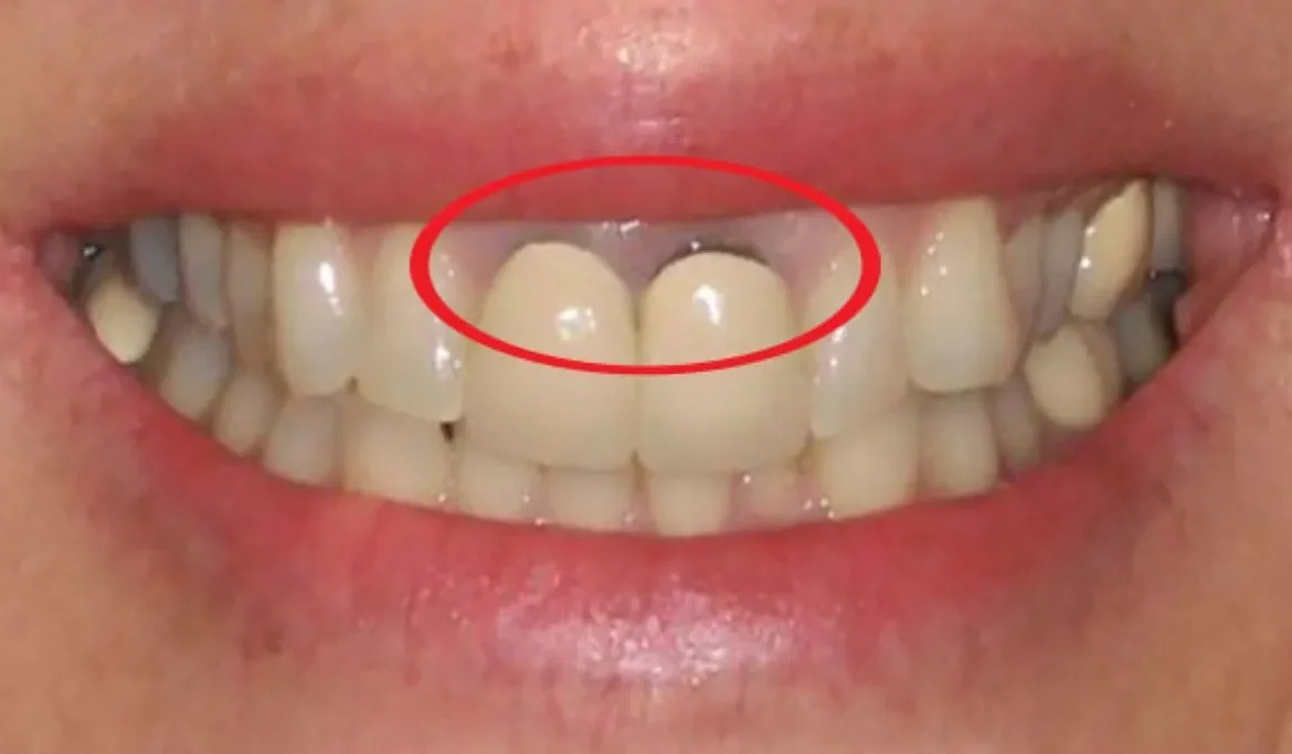 nướu răng bị đen