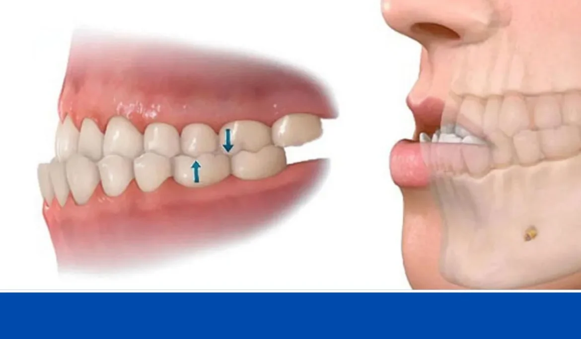 khớp cắn ngược