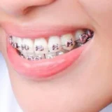 khớp cắn đối đầu