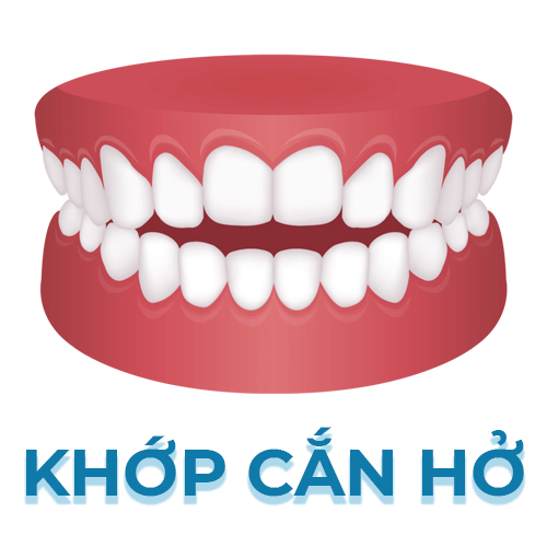 khớp cắn hở