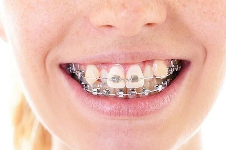 các trường hợp niềng răng