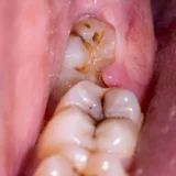 cách chữa đau răng số 8