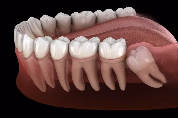 cách chữa đau răng số 8