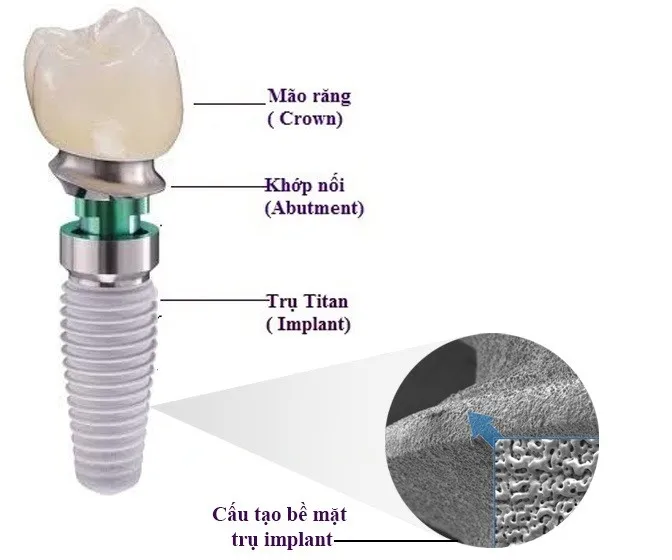 cấu tạo implant