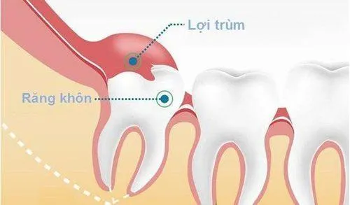 cách để răng khôn mọc thẳng
