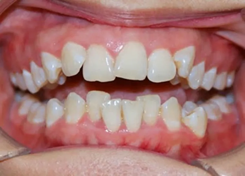 hàm răng dưới không đều
